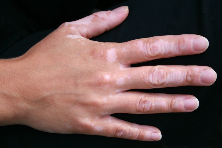Vitiligo : Une maladie très répandue mais mal connue.