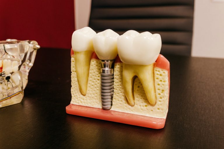 Revue : Utilisation de biomatériaux dans les implants dentaires